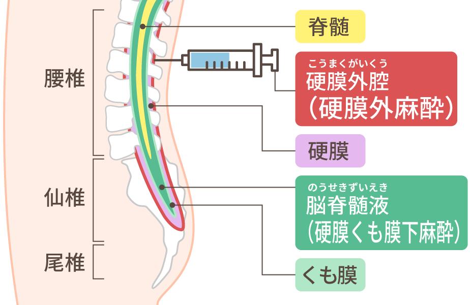 無痛分娩処置