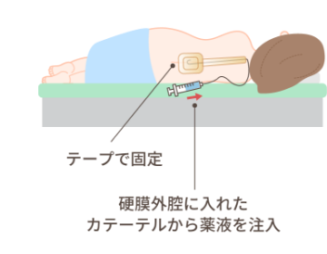 無痛分娩処置