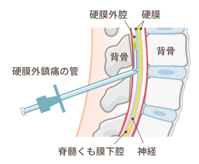 硬膜外麻酔